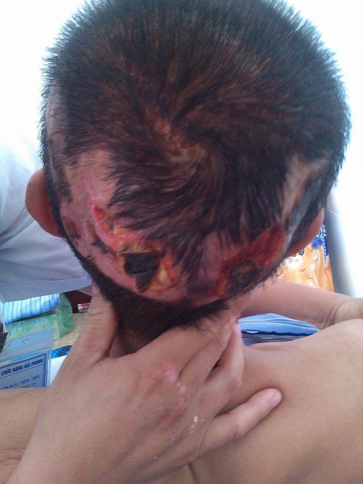 Loét do tỳ đè